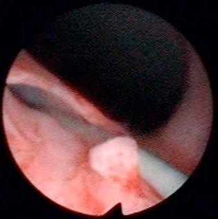 Ectopic ureter kimba0006 Ectopic ureter kimba0006